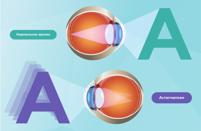 Как видят люди с астигматизмом и как его лечить